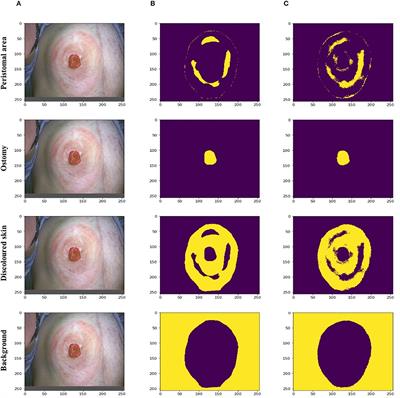 Automated Assessment of Peristomal Skin Discoloration and Leakage Area Using Artificial Intelligence